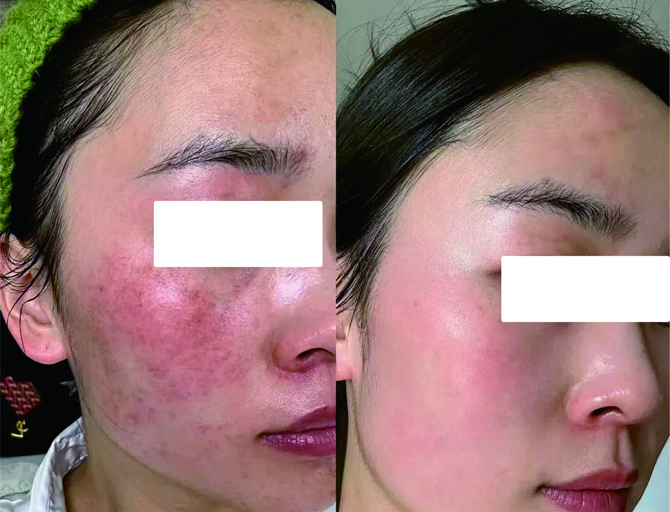敏感肌案例